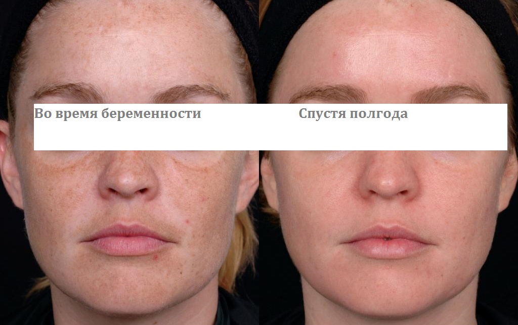 пигментные пятна у беременных как выглядит пигментные пятна у беременных как выглядит
