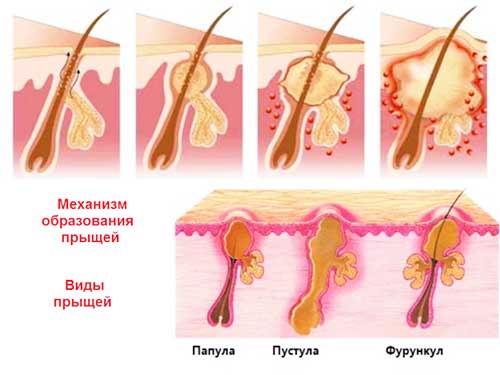 как образуется прыщ