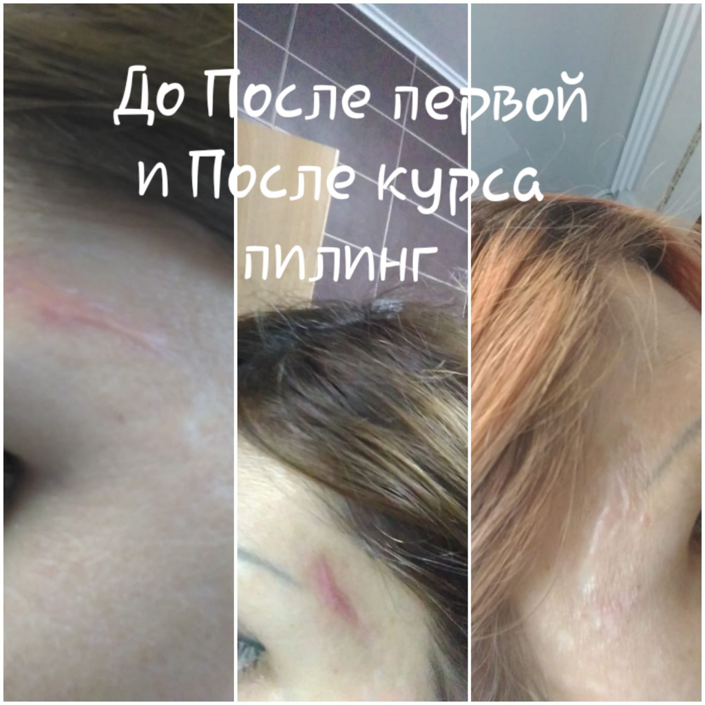 Пилинг кислотами_Как удалить шрамы_До_После 1 процедуры_После курса