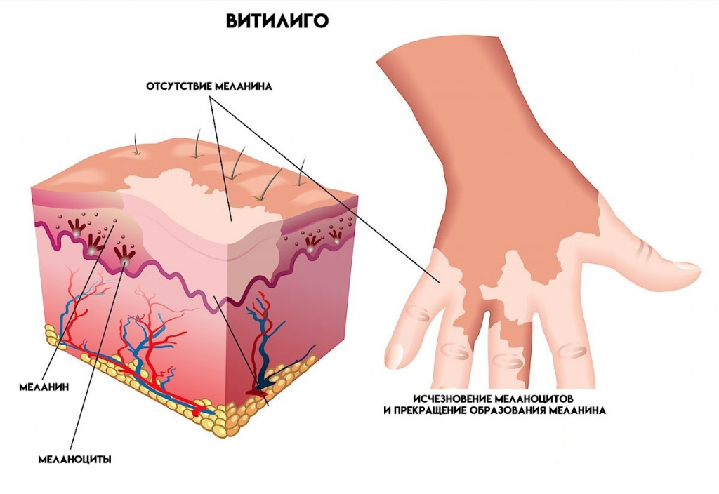 Vitiligo.jpg Vitiligo.jpg