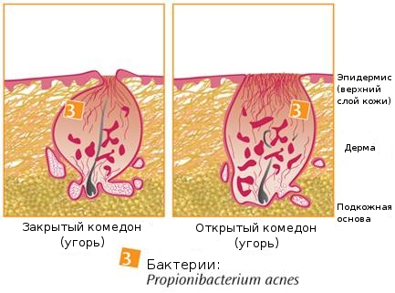 как избавится от акне и жирного блеска