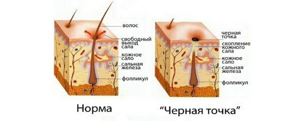 как убрать черные точки на носу и лице