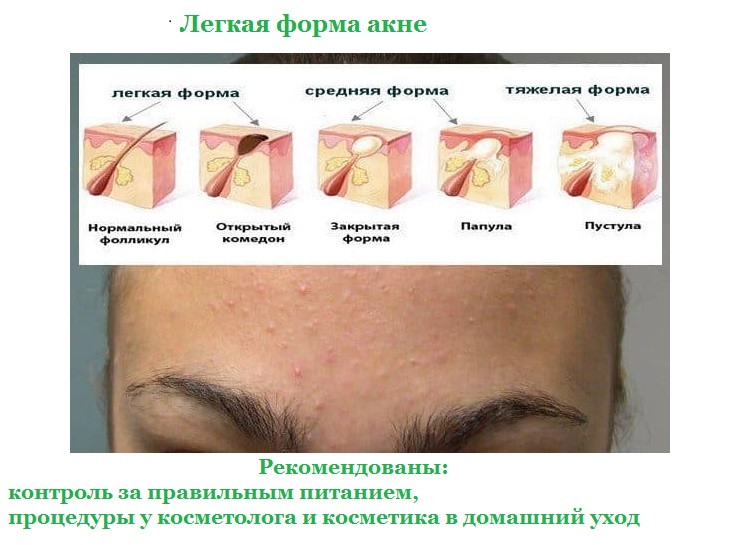 Косметолог проводит процедуры только для легкой формы акне 