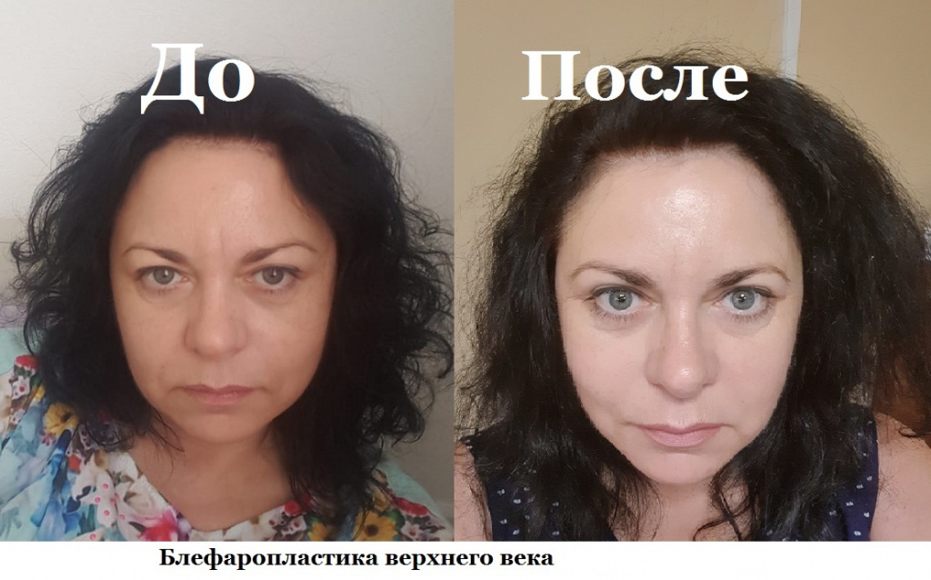 блефаропластика верхних век реабилитация отзывы прооперированных