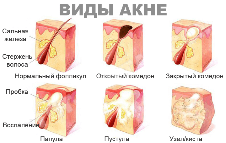 Формы акне