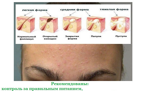 Правила ухода за подростковой кожей дома ч.1